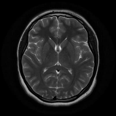 снимок МРТ головного мозга